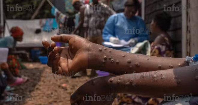 Mpox&nbsp;: Près de 2 000 décès recensés en Afrique depuis 2024 malgré une décrue des cas